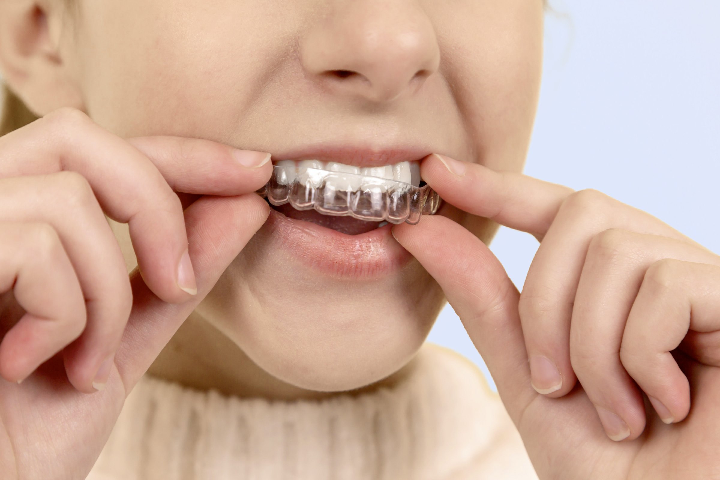 Invisalign, Retainers, and Night Guards Excel Dental San Diego